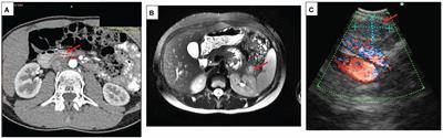 Insulinoma in childhood: a retrospective review of 22 patients from one referral centre
